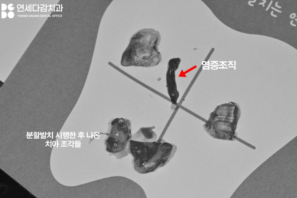 사랑니 부위 잇몸이 붓고 음식물이 자주 껴요 가락동 치과 매복사랑니 발치 후 지혈제 꼭 써야 좋을까? 관련 이미지 6