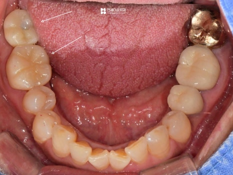 개롱역치과 아프기 전에 발견해야 되는 이유 인접면 충치 치료 관련 이미지 8