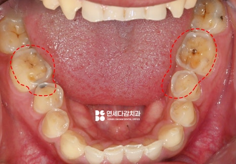 마모로 인한 치아 교모증 문정동 치과 에서 원인과 크라운 치료 방법 알려드리겠습니다. 관련 이미지 5