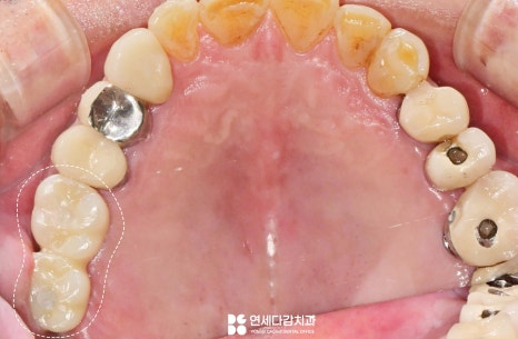 어금니 찌릿한 통증 치아에 금갔을때 신경치료 크라운 가락시장역 치과 충치 깊을 때 당일 발치 임플란트 및 부러진 보철 임플란트재식립 관련 이미지 13