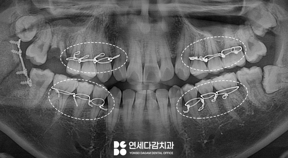문정역 치과 에서 알아보는 턱뼈 골절 됐을 때 악간고정술 치료 같이 진행하는 이유 관련 이미지 3