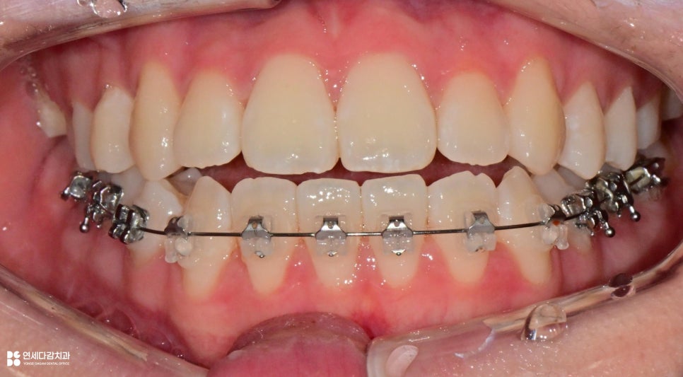 가락동 치과 교정 치료 전 사랑니 발치 꼭 필요할까? - 미성숙 매복케이스로 알아보는 과정 관련 이미지 1