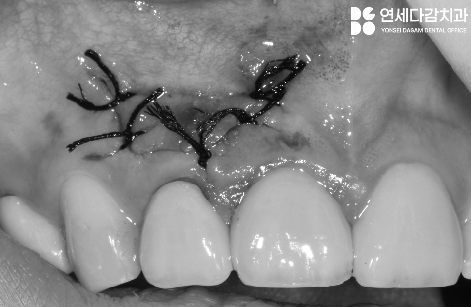 치아 발치를 피하기 위한 마지막 수단 MTA 이용한 가락동 치과 치근단 절제술 과정 살펴봅시다. 관련 이미지 6