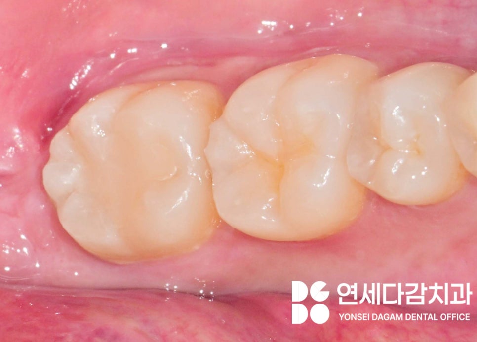 충치 범위에 따른 치료 방법 가락동 치과 레진 또는 인레이 언제 적용할 수 있을까? 관련 이미지 6