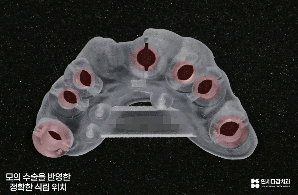 개롱역 치과 치주 질환으로 인한 심한 잇몸뼈 손실 - 네비게이션 방식 임플란트로 진행된 안전한 치료 관련 이미지 10