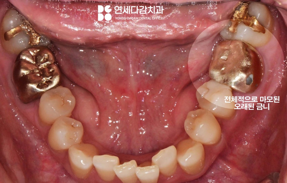 거여역 치과 미다졸람 수면마취 의식하진정법 임플란트 수술 말고 스케일링 크라운 치료 과정에서도 쓰이는 이유 관련 이미지 1