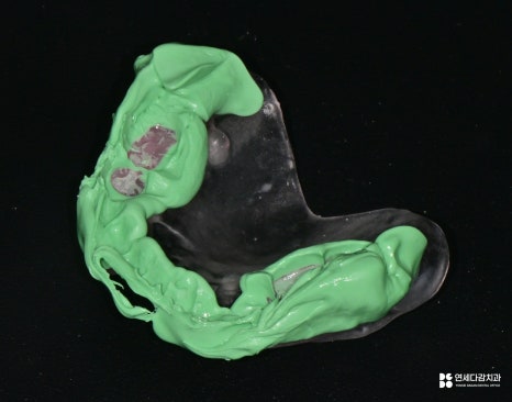 개롱역 치과 치주 질환으로 인한 심한 잇몸뼈 손실 - 네비게이션 방식 임플란트로 진행된 안전한 치료 관련 이미지 8