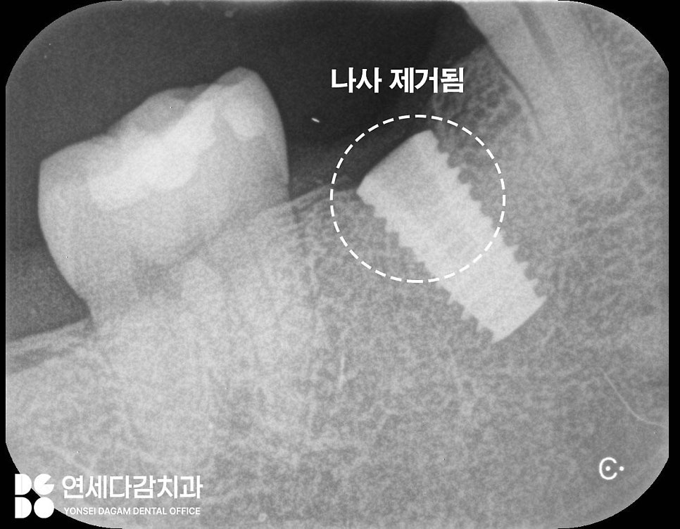 임플란트 빠짐 또는 흔들림 거여역 치과 나사 부러지고 빠졌을 때 재수술 없이 보철 크라운 교체할 수 있는 방법 관련 이미지 8