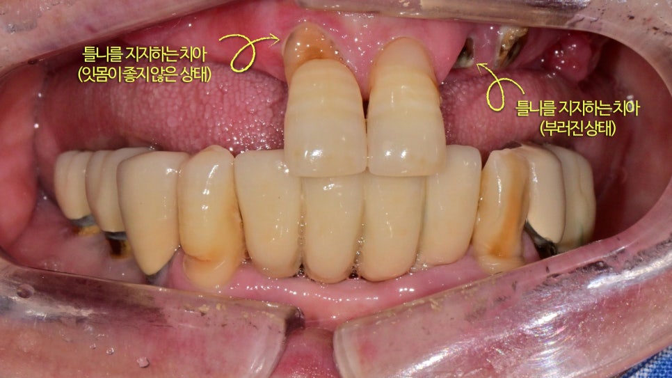 Songpa Station Dentist: Have You Been Using Dentures for a Long Time? <Digital Guided Implants> image 2