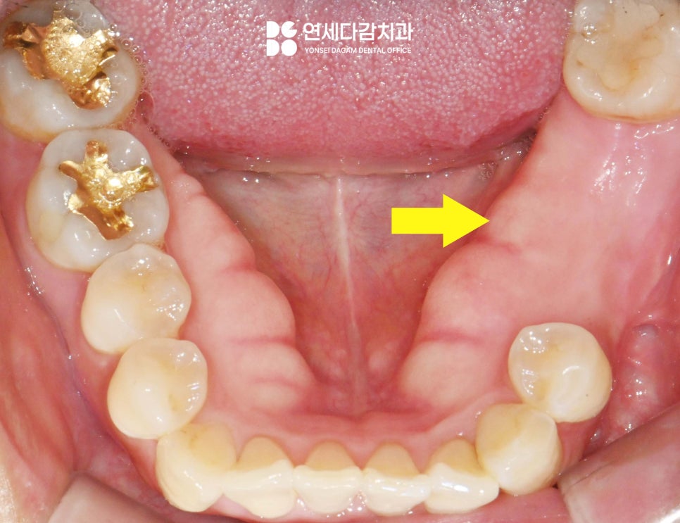턱뼈에 발생하는 법랑모세포종 거여동 치과 에서 원인과 치료 방법 알려드리겠습니다. 관련 이미지 3