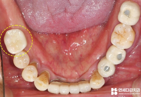 불편한 틀니 임플란트로 바꿔 치료할 수 있을지 가락시장역 치과 에서 살펴봅시다. 관련 이미지 10