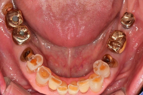Munjung-dong Dentist: What Does Tooth Attrition Mean, What Are Its Symptoms, and How Is It Treated? image 4