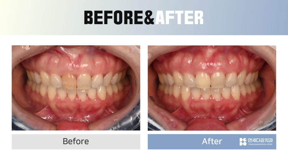 Geoyeo-dong Dental Clinic: Case of Internal Bleaching for a Discolored Front Tooth After Trauma image 8