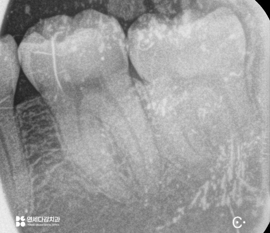 오금역 치과 후방 경사 부분 매복 사랑니, 조기 진단과 안전한 치료를 위한 가이드 관련 이미지 3