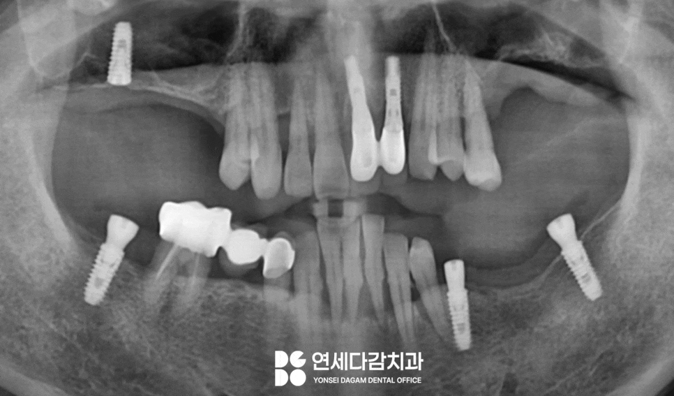 가락동 치과 오스템 임플란트 결과를 좌우하는 핵심 요소 표면처리 기술의 중요성 관련 이미지 2