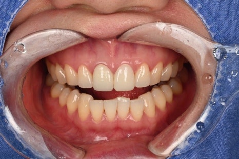 Songpa-dong Dentist: It Wasn’t Just the Front Crown That Was Replaced! A retreatment case that also considered the gum line image 5