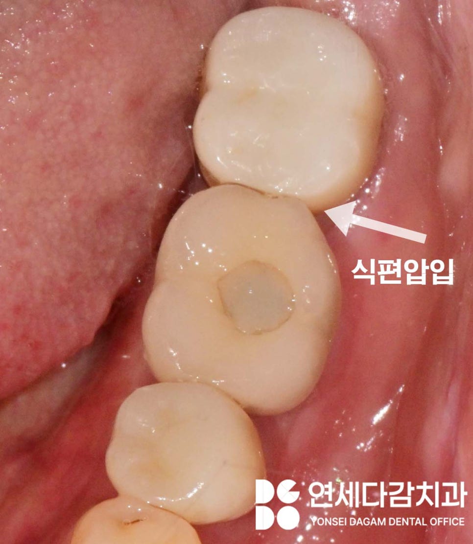 개롱역 치과 오스템 임플란트 종류의 다양성과 형태 구분법, 이것을 이용한 재수술 없는 보철 치료 관련 이미지 1
