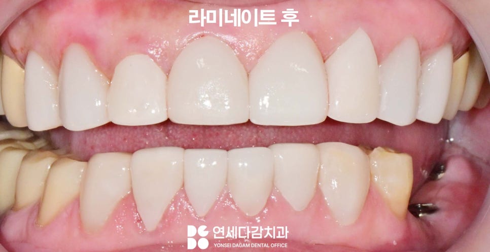하얀 치아가 가져오는 인상의 변화 오금동 치과 교정 없이 최소삭제 라미네이트 심미치료 통해 치열 및 누렁니 개선 관련 이미지 6