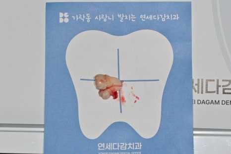 Garak-dong Wisdom Tooth Extraction: What If Two Wisdom Teeth Grew Fused Together? [A Case of Fused Wisdom Tooth Extraction] image 8