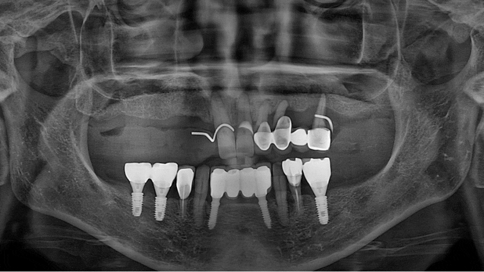Prosthetics After Implants in Ogeum-dong: Occlusion and Facial Balance Matter Too image 8