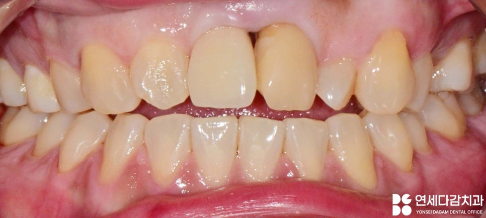 앞니 벌어짐 거여동 치과 치은성형술 동반하여 교정 없이 크라운 교체 및 최소삭제 라미네이트 통한 심미 치료 관련 이미지 1