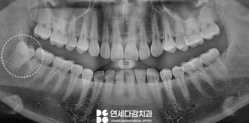 거여동 치과 매복 사랑니 발치 후 치아 뿌리 조각 부러짐 잔존치근 일부러 남겨두는 이유 관련 이미지 2