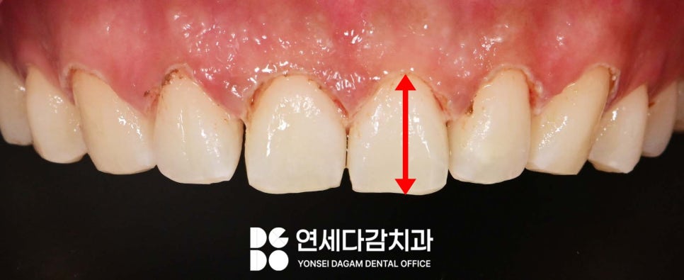 연세다감치과 심미 치료 무삭제 라미네이트 통해 자신감 있는 미소를 되찾는 여정 관련 이미지 6