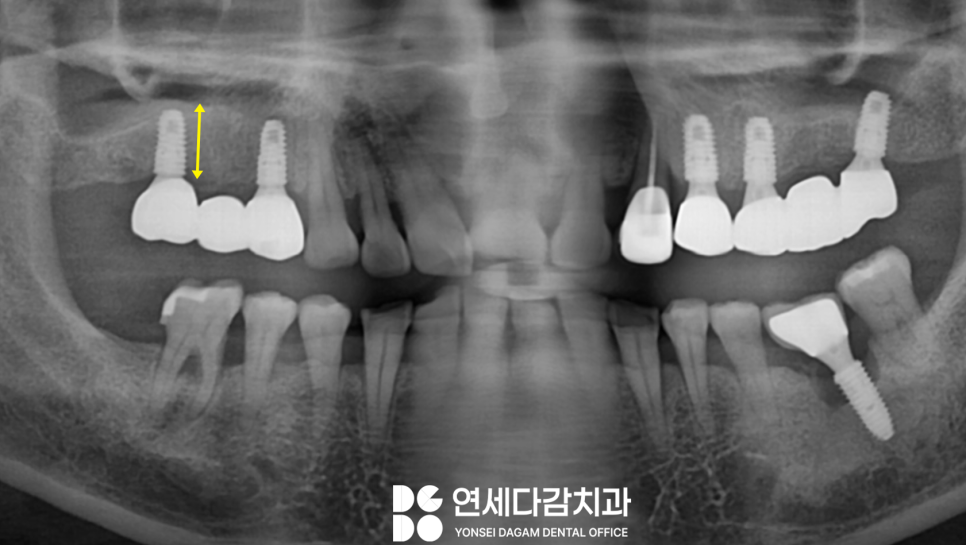 뼈가 부족해도 상악동 거상술을 통한 문정동 치과 뼈이식 임플란트 과정 관련 이미지 2