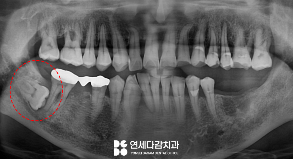 신경과 가까운 매복 사랑니 절반만 잘라서 남긴다고요? 오금역 치과 에서 알려드리는 치관절제술 통한 안전한 발치! 관련 이미지 1