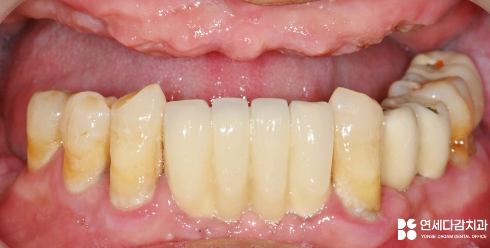 불편한 틀니 임플란트로 바꿔 치료할 수 있을지 가락시장역 치과 에서 살펴봅시다. 관련 이미지 2