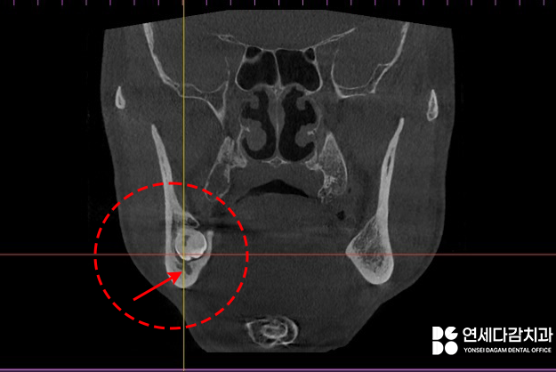 신경과 가까운 매복 사랑니 절반만 잘라서 남긴다고요? 오금역 치과 에서 알려드리는 치관절제술 통한 안전한 발치! 관련 이미지 2