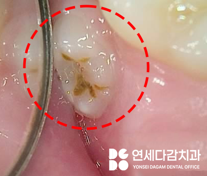 매복 사랑니 옆에 또 다른 치아 이것은 무엇일까요 송파구 가락동 치과 에서 알려드리겠습니다. 관련 이미지 6