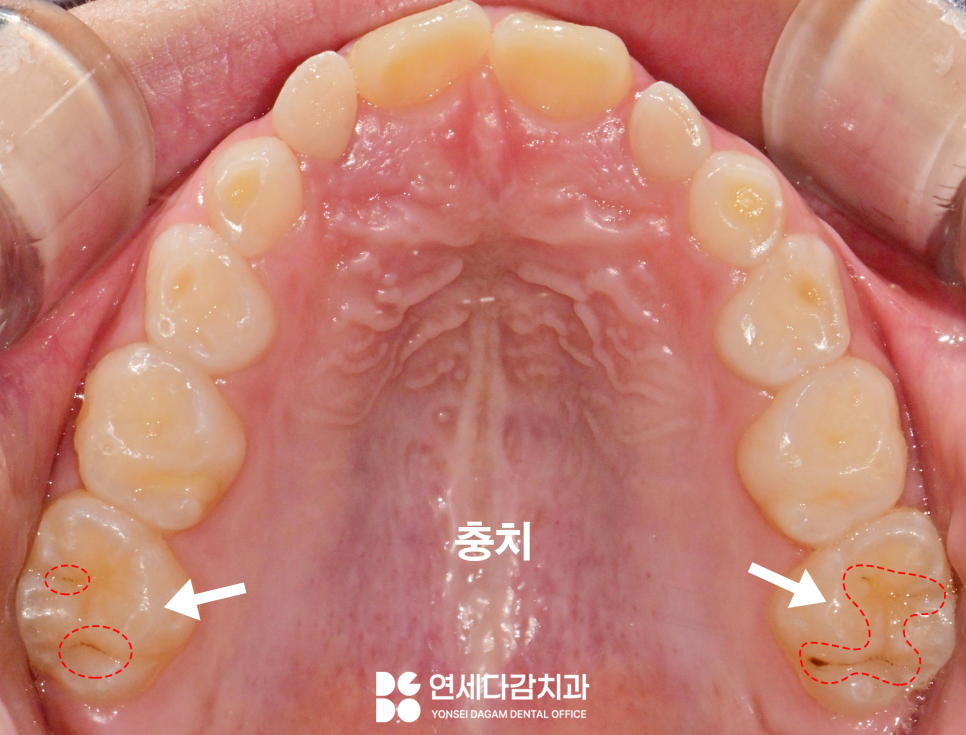 오금동 치과 충치 레진 치료 보험 혜택받을 수 있을까 우리 아이 구강 건강을 위한 치아 우식 예방법 관련 이미지 2