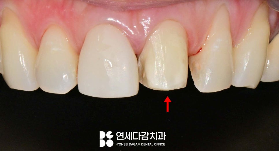 과거와 다르게 앞니 무삭제 라미네이트 가능한 이유 거여역 치과 앞니 보철 깨짐 추가 삭제 없이 재제작 관련 이미지 3