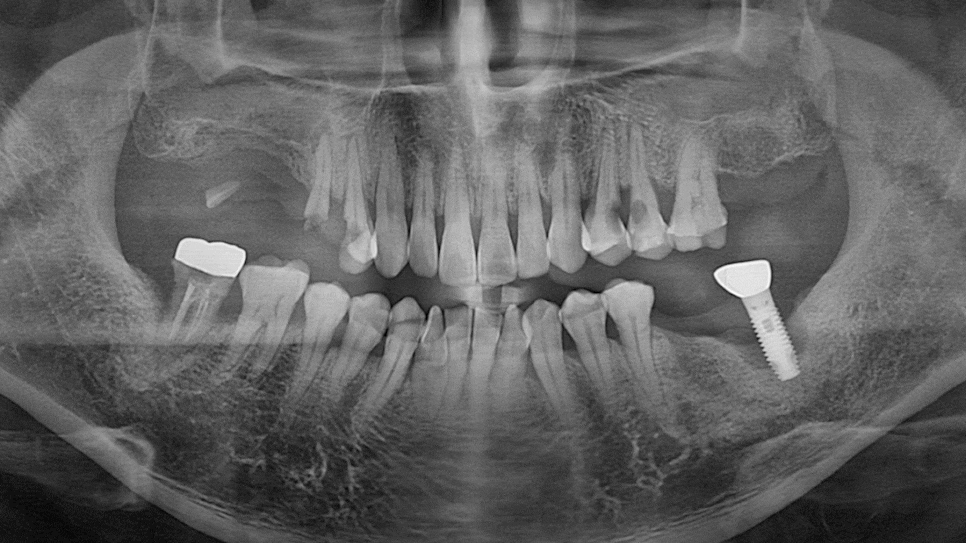 Why a Sinus Lift May Be Needed When There Is Insufficient Bone for Implants in Munjeong-dong image 7