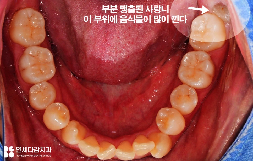 사랑니 부위 잇몸이 붓고 음식물이 자주 껴요 가락동 치과 매복사랑니 발치 후 지혈제 꼭 써야 좋을까? 관련 이미지 1
