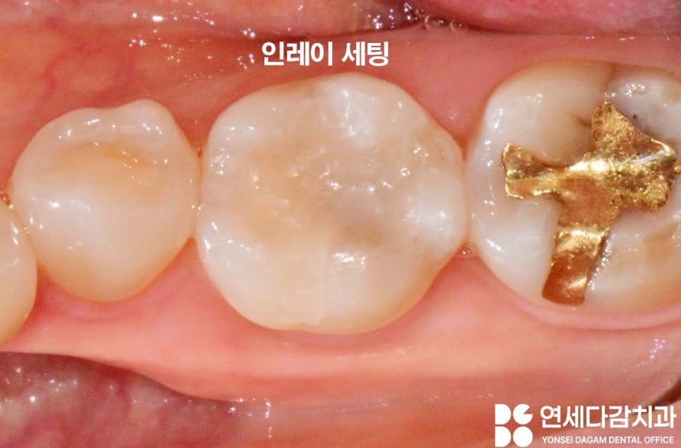 오금역 치과 어금니 골드 인레이 떨어짐 재치료 꼭 필요할까 탈락한 원인 파악이 중요한 이유와 보철 종류 특징 관련 이미지 3