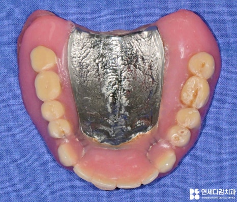 항암 치료 전 발치 필요할 때 기존 부분틀니 송파동 치과 에서 보철 수정 후 임시로 완전틀니 만든 이유 관련 이미지 7