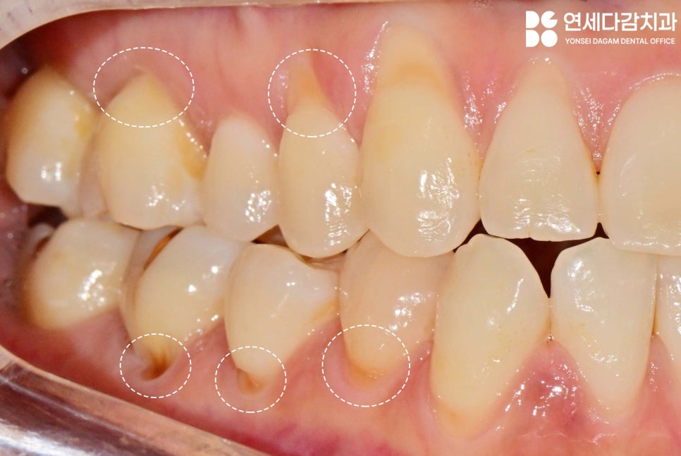 이시림 원인 치경부 마모증 치료할 때 쓰이는 문정역 치과 레진과 G.I 재료의 특성 관련 이미지 4