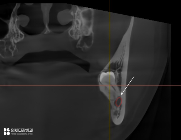 오금역 치과 후방 경사 부분 매복 사랑니, 조기 진단과 안전한 치료를 위한 가이드 관련 이미지 5