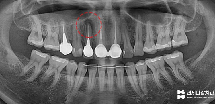 치아 발치를 피하기 위한 마지막 수단 MTA 이용한 가락동 치과 치근단 절제술 과정 살펴봅시다. 관련 이미지 1