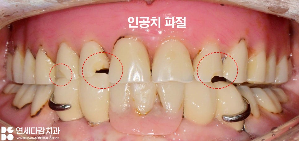 거여동 치과 임플란트 틀니 깨졌을 때 오버덴처 overdenture 종류 및 수리 기간 관련 이미지 6