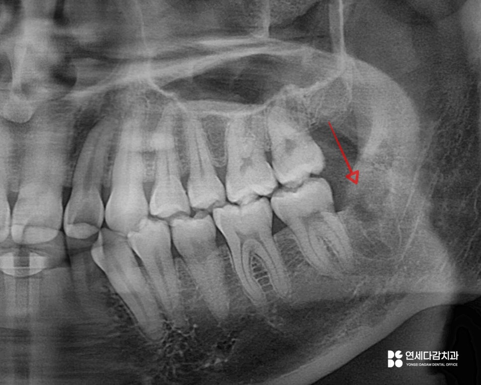 오금역 치과 후방 경사 부분 매복 사랑니, 조기 진단과 안전한 치료를 위한 가이드 관련 이미지 7