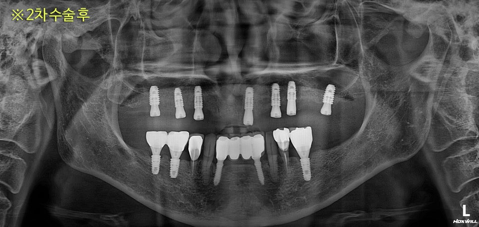 Prosthetics After Implants in Ogeum-dong: Occlusion and Facial Balance Matter Too image 3