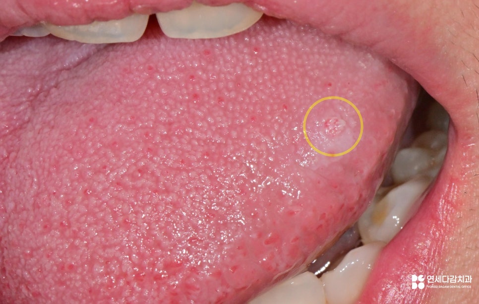 A Bump on the Side of the Tongue: From the Appearance of Oral Papilloma to Treatment | Gaerong Station Dental Clinic image 1