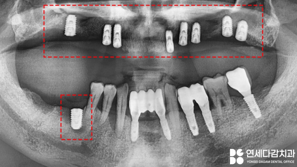 불편한 틀니 임플란트로 바꿔 치료할 수 있을지 가락시장역 치과 에서 살펴봅시다. 관련 이미지 7