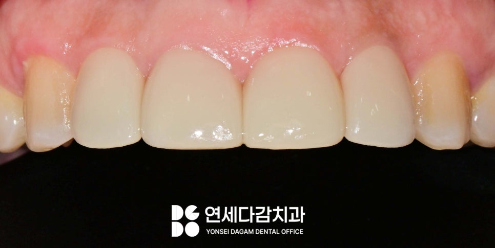 송파동 치과 앞니 사이 벌어짐 라미네이트 부분적으로 가능할까? 관련 이미지 4