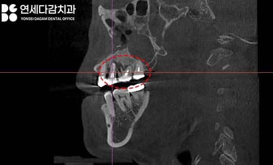 축농증 수술 후에도 임플란트 수술 가능할까? 특별한 송파구 치과 케이스의 해결책 관련 이미지 4