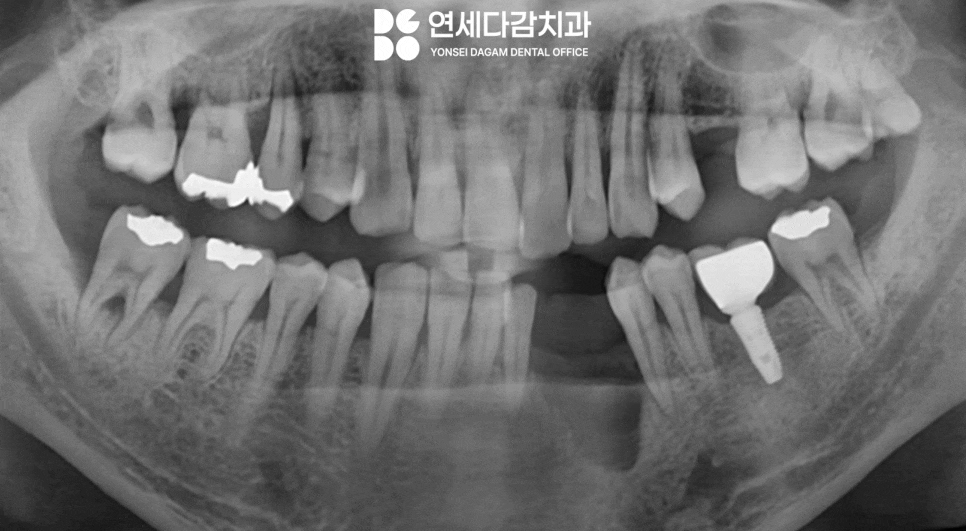 심한 골소실에도 임플란트 가능할까요 가락시장역 치과 뼈이식 통한 안정적인 고정력 확보 과정 관련 이미지 1