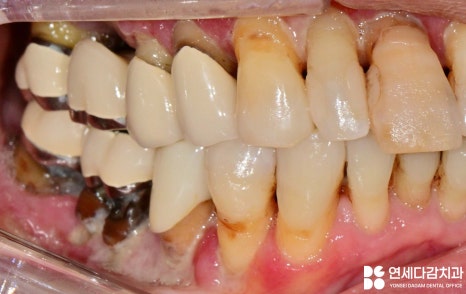 잇몸이 붓고 피나고 냄새날 때 송파역 치과 구강암 증상과 비슷한 급성 궤양성 치은염 (ANUG) 잇몸치료 통한 치주질환 개선 관련 이미지 2